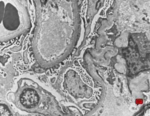 M,67y. | normal kidney